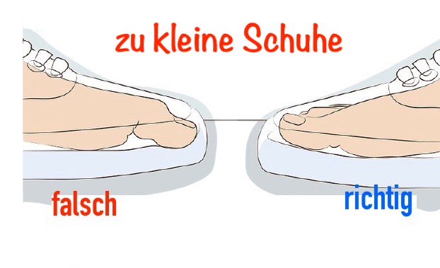 Holznagel am Zeh, verdickte, gelbe Fußnägel, kein Pilz