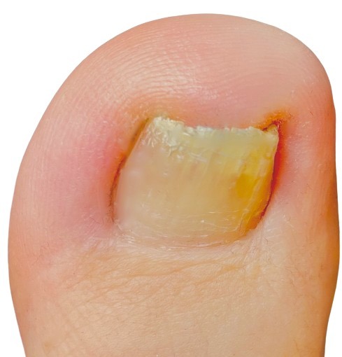 Gelbe Fußnägel – kein Pilz. Ursachen und Pflege mit Fußnagel Spray von Jenn Cosmetic.