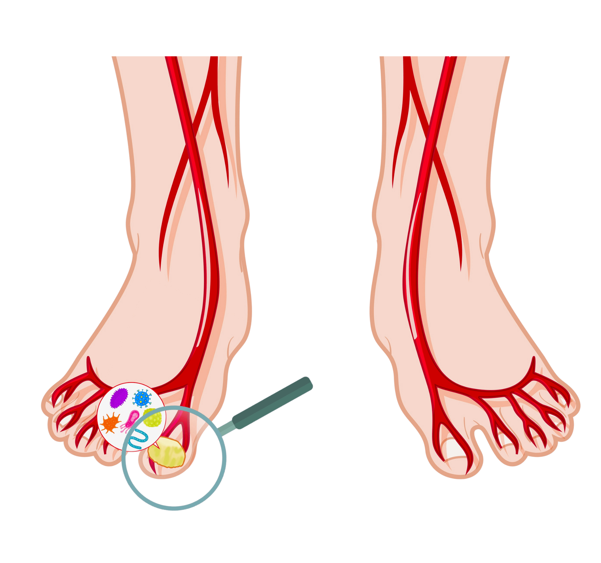 Holznagel am Zeh. Verdickte Zehennägel kein Pilz