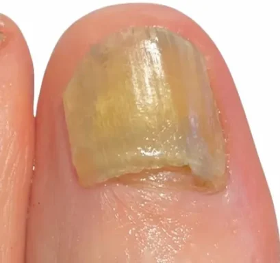 Dieses Bild zeigt extremen Befall: Wie sieht Nagelpilz aus, wenn die Struktur völlig zerstört ist? Fortgeschrittener Fall: Wie sieht Nagelpilz aus, wenn die Nagelplatte verdickt ist.