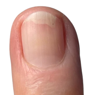 Nagelpilz_Finger_Nagelpilz_am_daumen_jenn_cosmetic