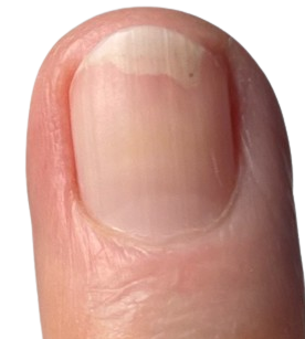 fingernagelpilz-nagelpilz finger