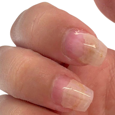 Nagelpilz_Finger_Nagelpilz_am_daumen_jenn_cosmetic