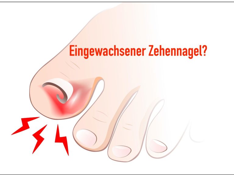 eingewachsener Zehennagel