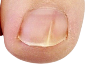 anfangsstadium-nagelpilz