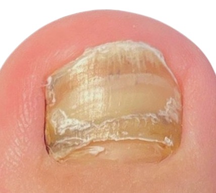 Wie sieht Nagelpilz aus? Erste weiße Flecken am Nagelrand. wie sieht nagelpilz aus, Otto